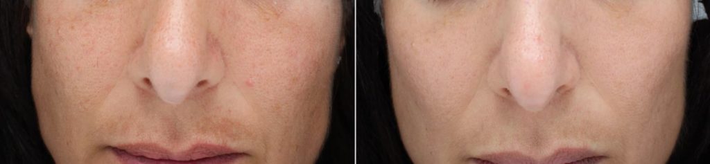 AlumierMD Before and After
