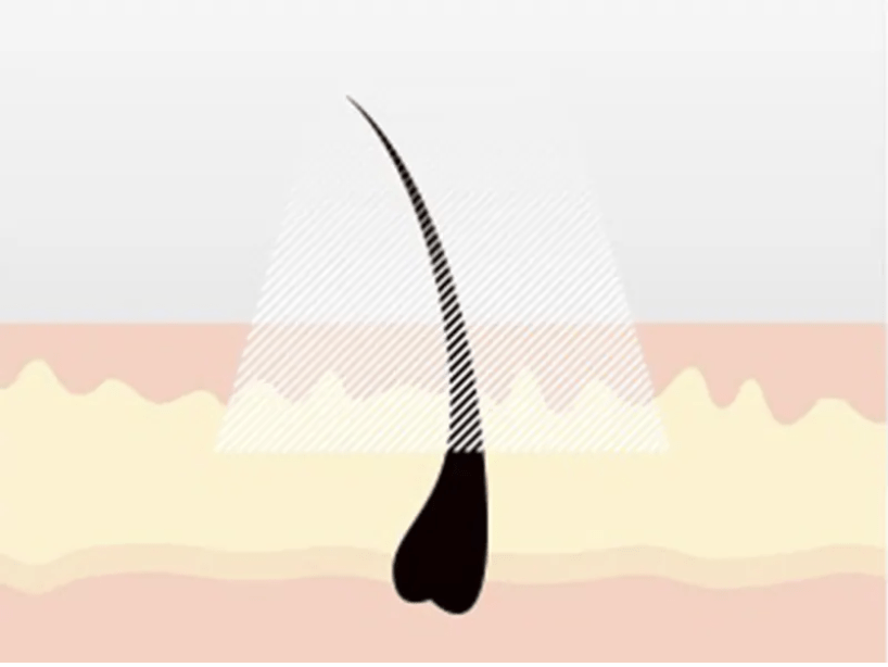 IPL Removal