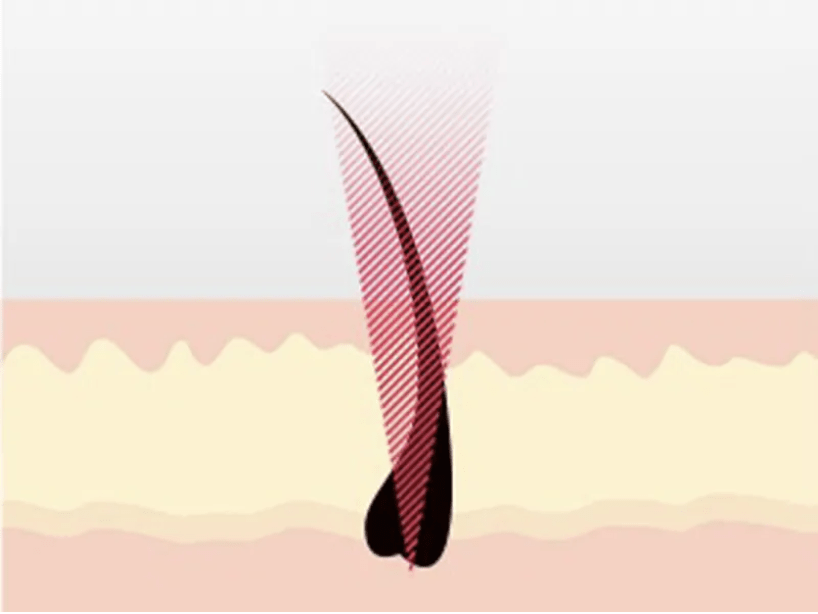 Laser Hair Removal