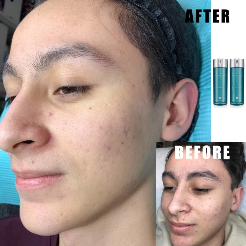 Microneedling Skincare Results